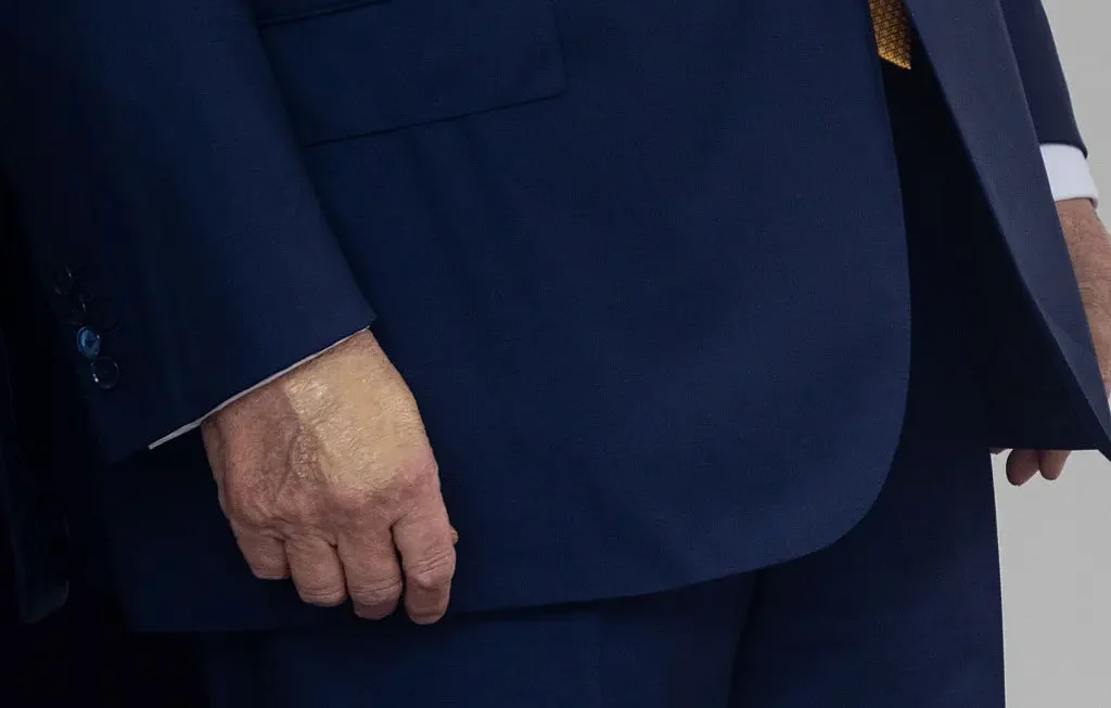 Trump Has Chronic Venous Insufficiency, White House Announces